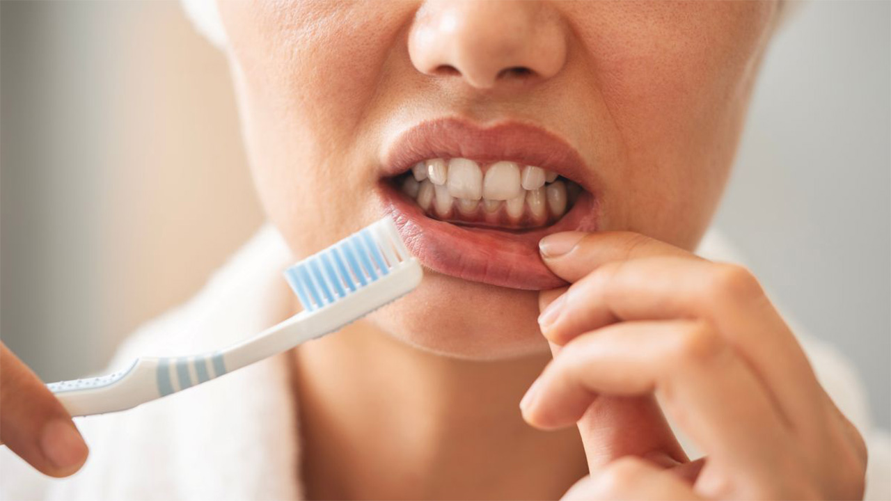 A woman with gum disease